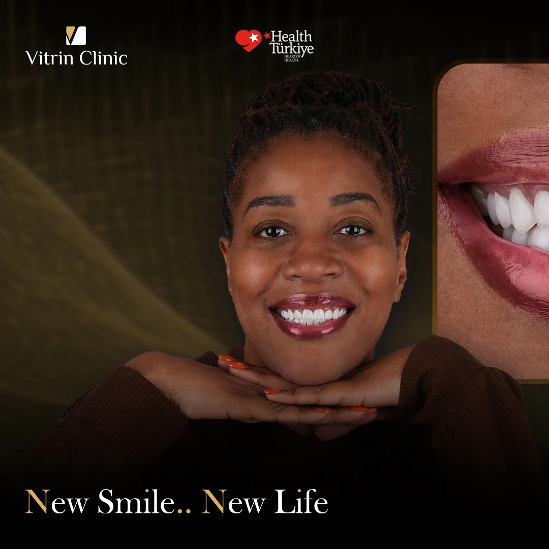 Can Veneers for Worn Teeth 4